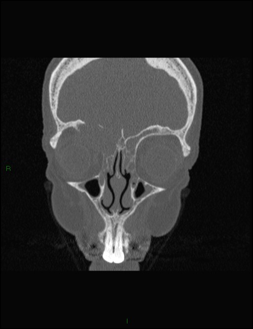 Bilateral frontal mucoceles (Radiopaedia 82352-96454 Coronal 100).jpg