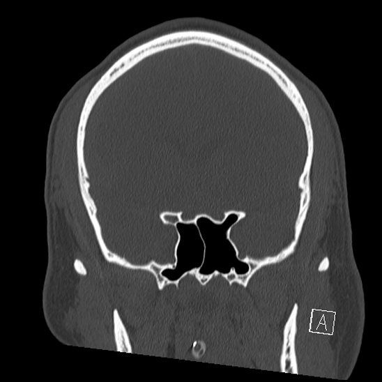 Bilateral occipital condyle fracture (type 2) (Radiopaedia 87675-104089 Coronal bone window 44).jpg