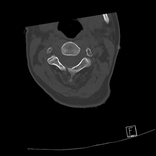 Bilateral occipital condyle fractures (type 3) (Radiopaedia 87672-104086 Axial bone window 27).jpg