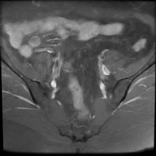 File:Bilateral ovarian dermoid cysts (Radiopaedia 90152-107338 Axial T1 C+ fat sat 6).jpg