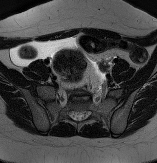 File:Bilateral ovarian fibrothecomas - adolescent (Radiopaedia 86604-102707 Axial T2 11).jpg