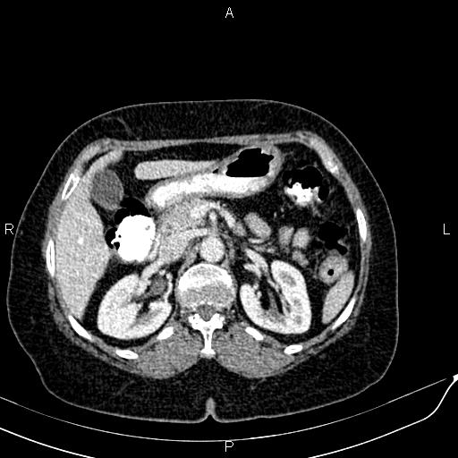 Bilateral ovarian serous cystadenocarcinoma (Radiopaedia 86062-101989 B 34).jpg