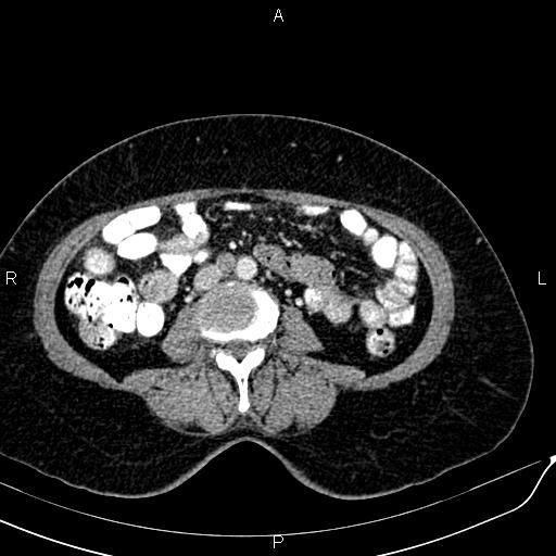 Bilateral ovarian serous cystadenocarcinoma (Radiopaedia 86062-101989 B 56).jpg