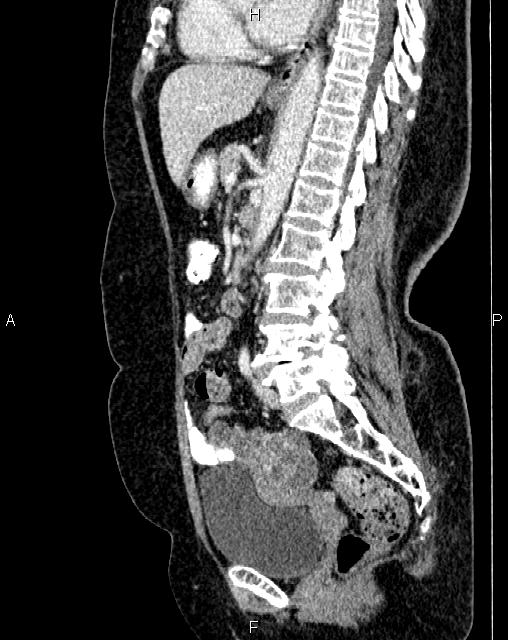 Bilateral ovarian serous cystadenocarcinoma (Radiopaedia 86062-101989 E 46).jpg