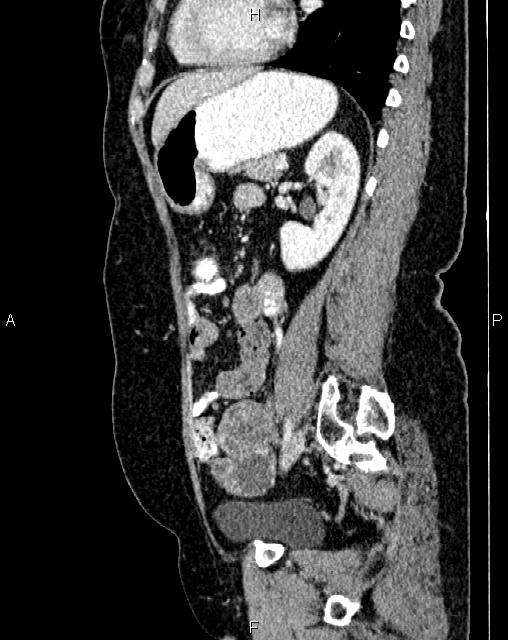 Bilateral ovarian serous cystadenocarcinoma (Radiopaedia 86062-101989 E 56).jpg