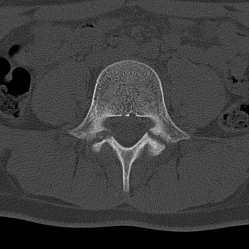 Bilateral pars defect (Radiopaedia 26691-26846 Axial bone window 30).jpg