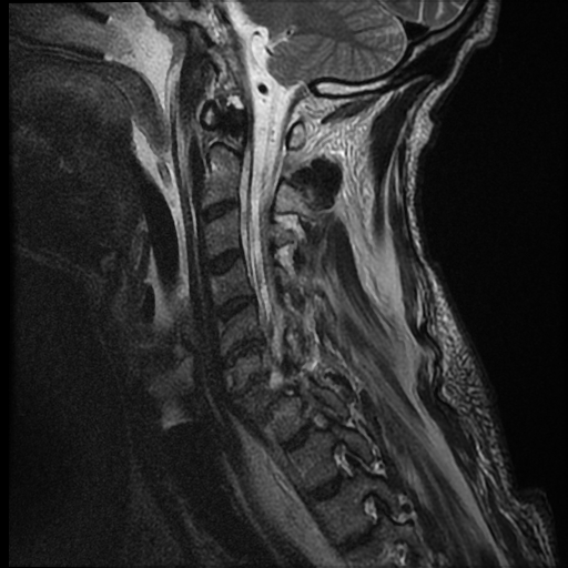 File:Bilateral perched facets with cord injury (Radiopaedia 45587-49714 Sagittal T2 11).jpg