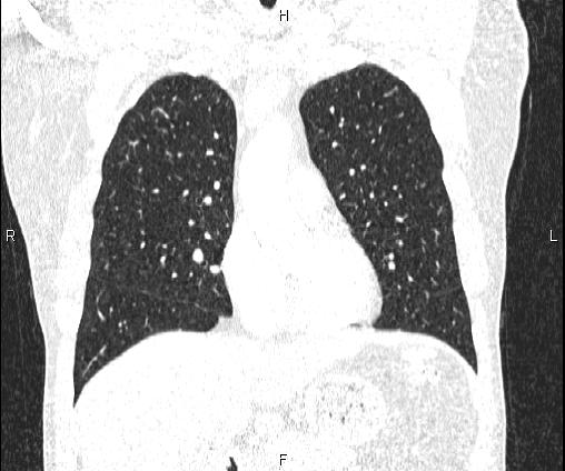 Bilateral pulmonary AVM (Radiopaedia 83134-97505 Coronal lung window 34).jpg