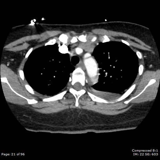 Bilateral pulmonary emboli with Hampton hump sign (Radiopaedia 54070-60246 Axial C+ CTPA 18).jpg
