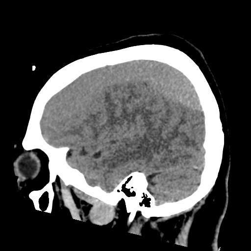 File:Bilateral subacute subdural hematoma (Radiopaedia 69240-79018 C 12).jpg