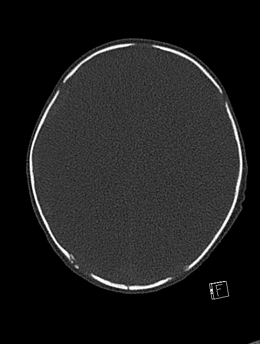 Bilateral subdural hemorrhage and parietal skull fracture (Radiopaedia 26058-26192 Axial bone window 45).png
