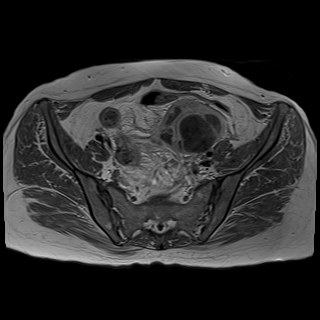 Bilateral tubo-ovarian abscesses (Radiopaedia 58635-65829 Axial T1 C+ 16).jpg