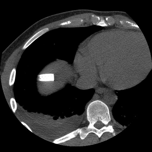 File:Bile leak from liver traumatic laceration (Radiopaedia 63463-72077 Axial Biliscopin 2).jpg