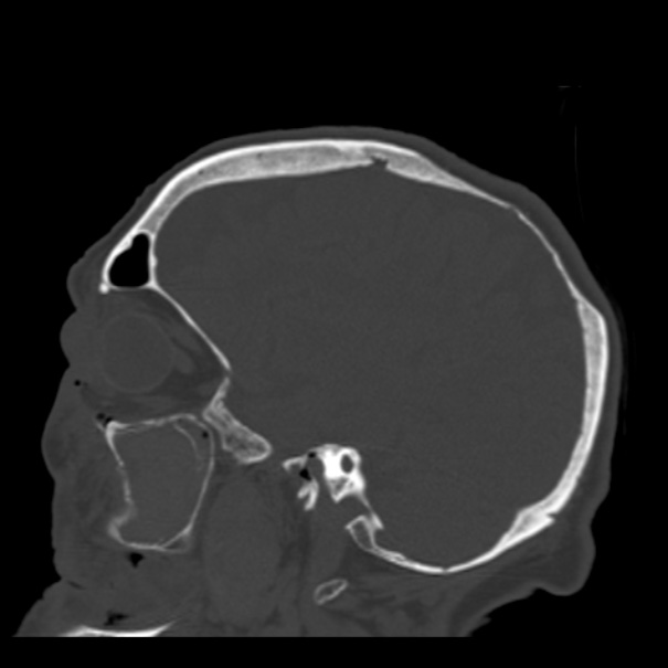 Biparietal osteodystrophy (Radiopaedia 46109-50463 Sagittal bone window 75).jpg