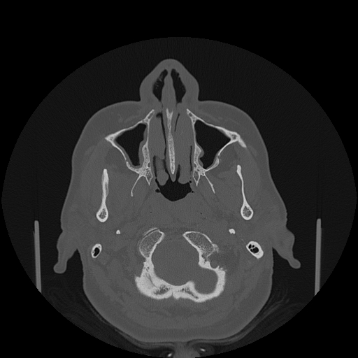 File:Bisphosphonate-related osteonecrosis of the jaw (Radiopaedia 71324-81642 Axial bone window 128).jpg
