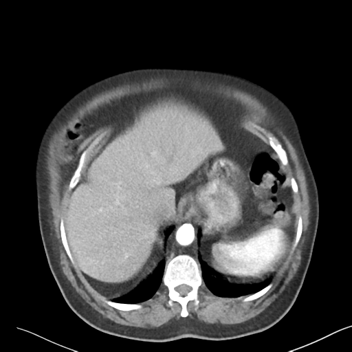 File:Bladder papillary urothelial carcinoma (Radiopaedia 48119-52951 A 5).png