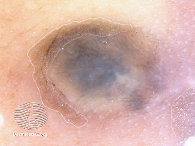 File:Blue naevus (DermNet NZ doctors-dermoscopy-course-images-cellular-blue).jpg