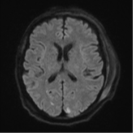 Blunt cerebrovascular injury (Radiopaedia 53682-59745 Axial DWI 48).png