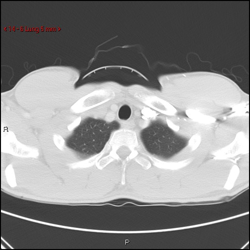 Blunt chest trauma - pulmonary interstitial emphysema and pneumomediastinum (Radiopaedia 20666-20552 Axial lung window 6).jpg