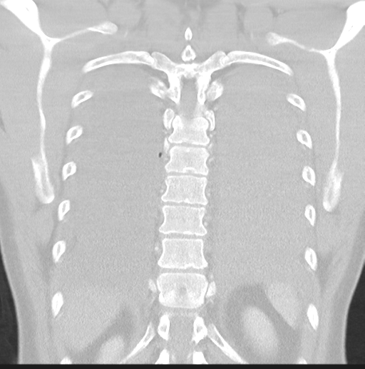 Boerhaave syndrome (Radiopaedia 39382-41661 Coronal lung window 41).png