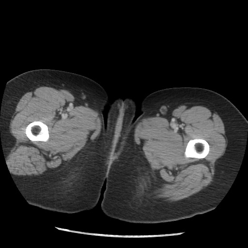 File:Borderline mucinous tumor (ovary) (Radiopaedia 78228-90808 A 149).jpg