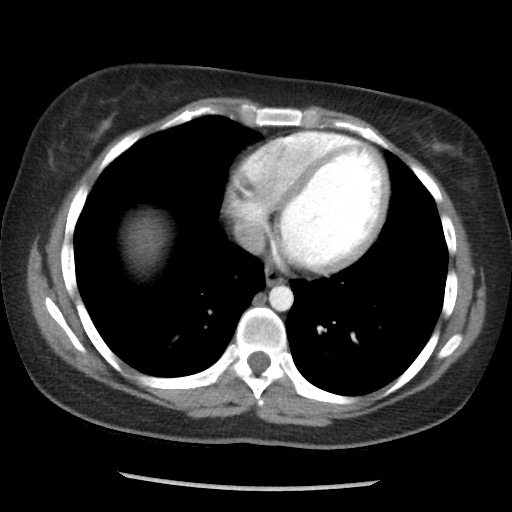 File:Borderline mucinous tumor (ovary) (Radiopaedia 78228-90808 A 32).jpg