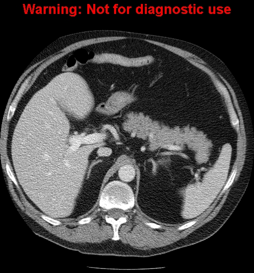 File:Bosniak renal cyst - type IV (Radiopaedia 23402-23466 D 18).jpg