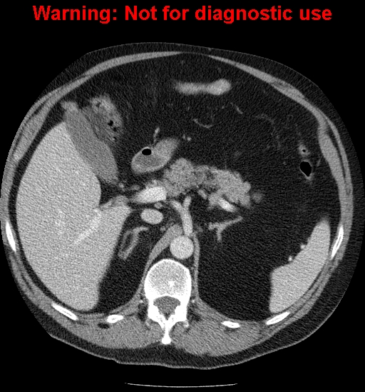 File:Bosniak renal cyst - type IV (Radiopaedia 23402-23466 D 20).jpg