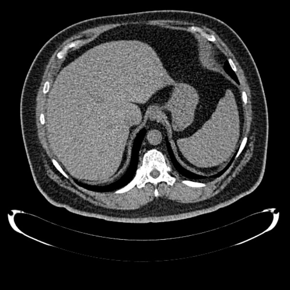 Bosniak renal cyst - type IV (Radiopaedia 24244-24518 Axial non-contrast 73).jpg