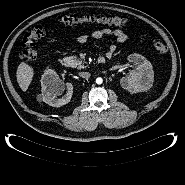Bosniak renal cyst - type IV (Radiopaedia 24244-24518 B 147).jpg