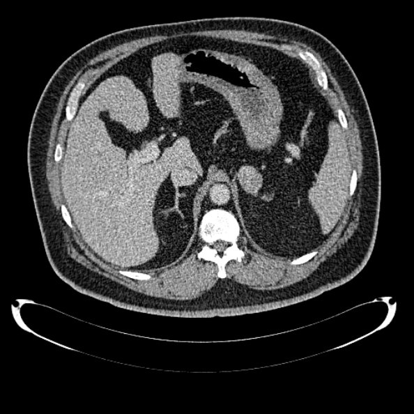 Bosniak renal cyst - type IV (Radiopaedia 24244-24518 C 75).jpg