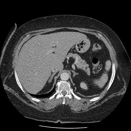 Bovine aortic arch - right internal mammary vein drains into the superior vena cava (Radiopaedia 63296-71875 A 173).jpg