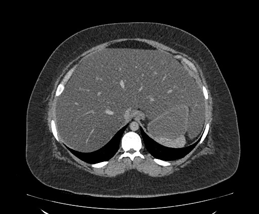 File:Bowel and splenic infarcts in acute lymphocytic leukemia (Radiopaedia 61055-68913 A 30).jpg