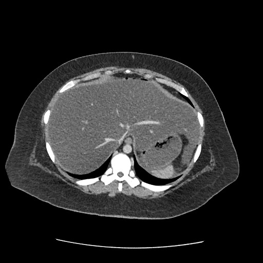 Bowel and splenic infarcts in acute lymphocytic leukemia (Radiopaedia 61055-68915 A 25).jpg