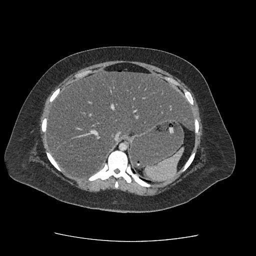 Bowel and splenic infarcts in acute lymphocytic leukemia (Radiopaedia 61055-68915 A 32).jpg