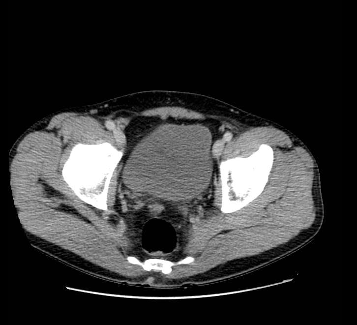 Bowel obstruction from colon carcinoma (Radiopaedia 22995-23028 A 78).jpg