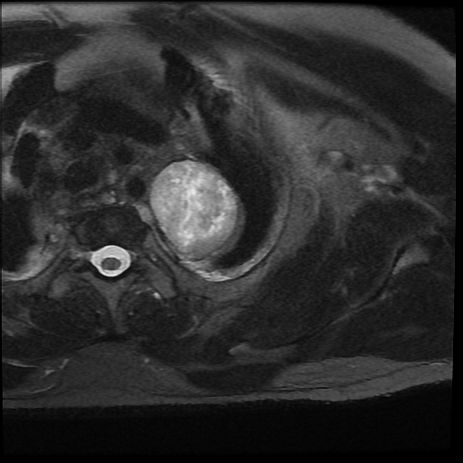 File:Brachial plexus neurofibroma (Radiopaedia 28030-28291 Axial T2 fat sat 5).png