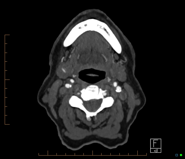 File:Brachiocephalic trunk stenosis (Radiopaedia 87242-103519 A 89).jpg