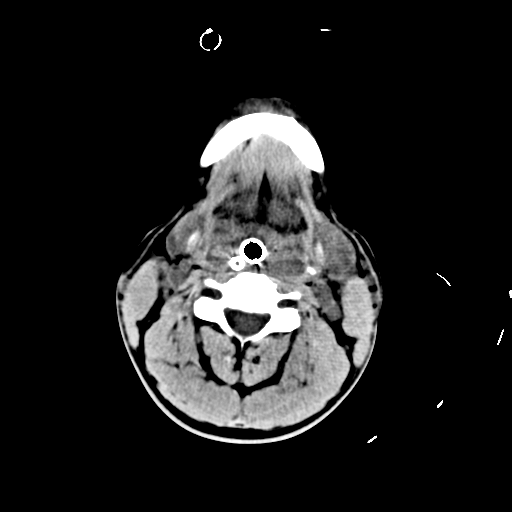 File:Brain contusions, internal carotid artery dissection and base of skull fracture (Radiopaedia 34089-35339 Axial non-contrast 3).png