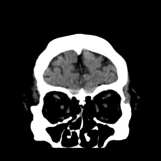 Brain cortical laminar necrosis (Radiopaedia 25822-25971 C 10).jpg