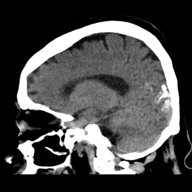 Brain cortical laminar necrosis (Radiopaedia 25822-25971 non-contrast 21).jpg