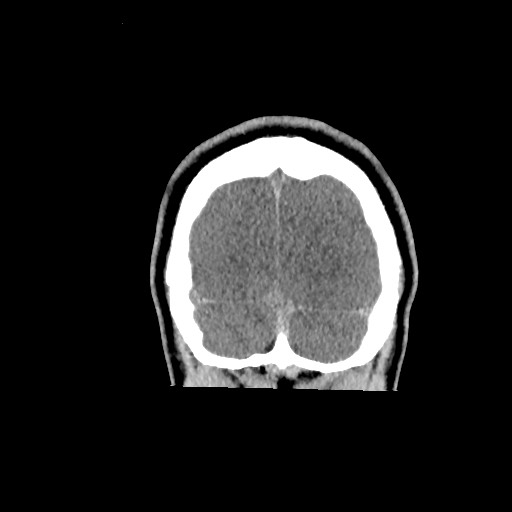 File:Brain death (Radiopaedia 78597-91360 Coronal non-contrast 68).jpg