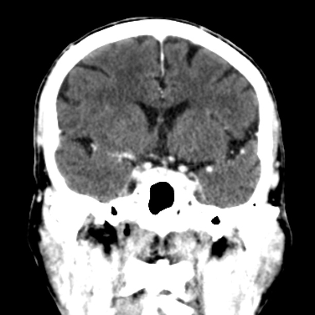 Brain metastases from lung cancer (Radiopaedia 27849-28092 Coronal C+ delayed 28).jpg
