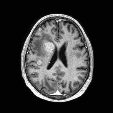 File:Brain metastases from lung cancer (Radiopaedia 83839-99028 Axial T1 C+ 41).jpg