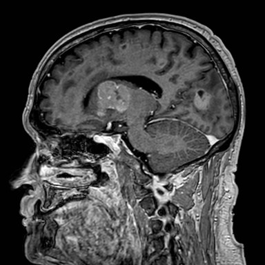 Brain metastases from lung cancer (Radiopaedia 83839-99028 Sagittal T1 C+ 26).jpg