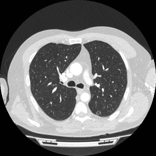 File:Brain metastases from lung cancer (Radiopaedia 83839-99030 Axial lung window 26).jpg