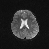 Brainstem glioma (Radiopaedia 67531-76922 Axial DWI 16).jpg