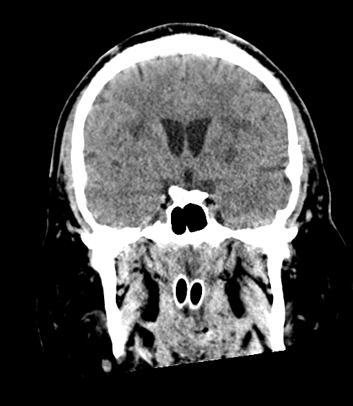 Brainstem hemorrhage (Radiopaedia 81294-94976 Coronal non-contrast 30).jpg