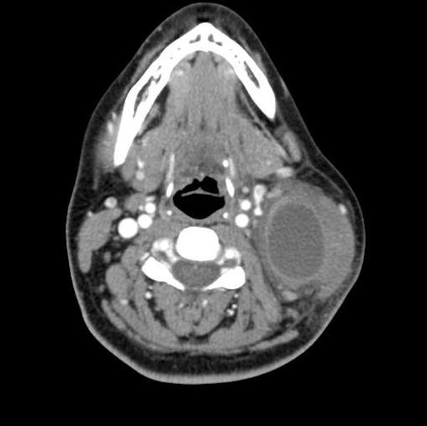 File:Branchial cleft cyst (Radiopaedia 11251-11615 C 1).jpg