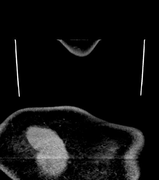 Branchial cleft cyst (Radiopaedia 31167-31875 Coronal C+ delayed 69).jpg